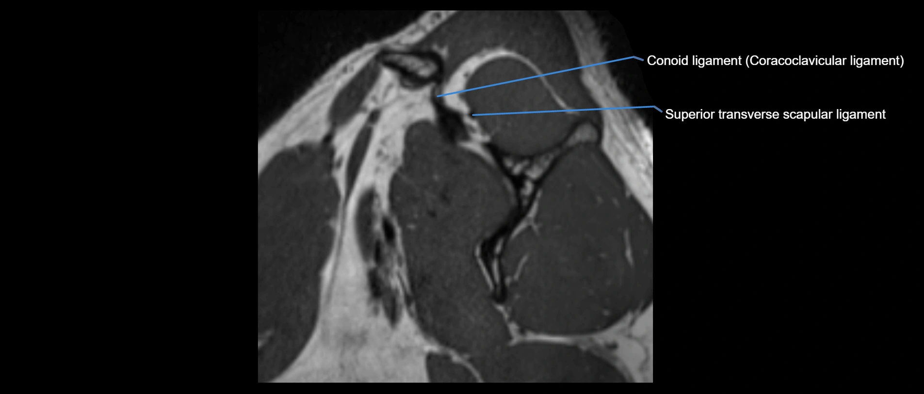 shoulder ligaments sagittal  cross sectional anatomy 3T MRI AI enhanced radiology image -img-00001-00010.webp